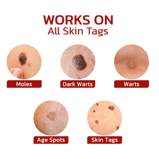 Wipe Off Tags and Mole Remover Pen