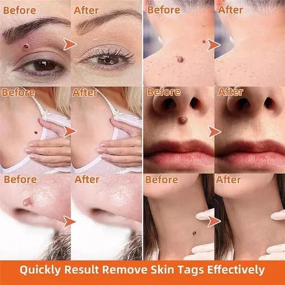 Warts & Moles Remover Pen (14 Days Money Back Guarantee)