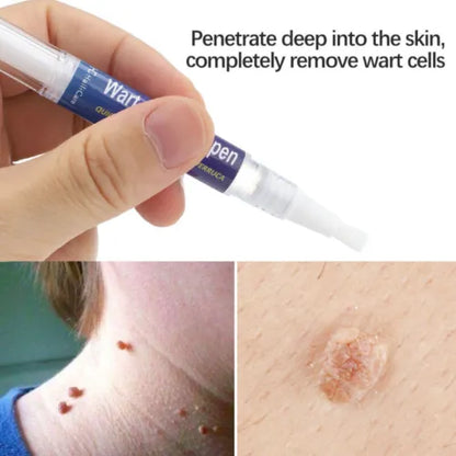 Warts & Moles Remover Pen (14 Days Money Back Guarantee)